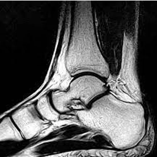mri left ankle joint